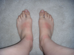 florida-with-bubbie-and-zaida-may-6-13-2008-i-forgot-to-put-suntan-lotion-on-my-feet-at-the-beach-resized.jpg